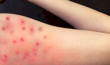 La OMS no cree que la viruela del mono se convierta en otra pandemia